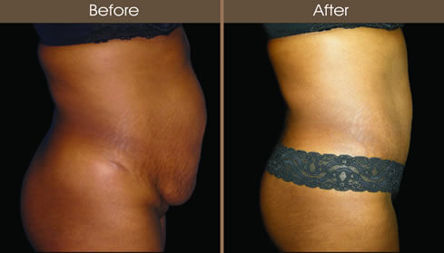 20123008125422_abdom_3_side_right